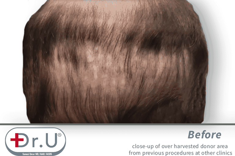 Failed growth and an exhausted donor area forced the patient to correct the situation using a partial hairpiece