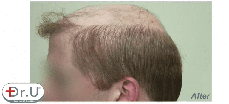 Final results of hairline and temples for this Redondo Beach patient's hairpiece integration surgery Final results of hairline and temples for this Redondo Beach patient's hairpiece integration surgery