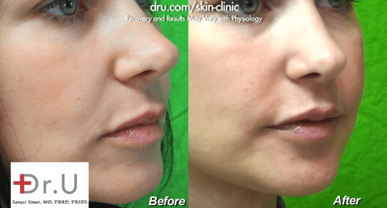 Different types of dermal fillers can be used to fill in laugh lines, also known as nasolabial folds. Radiesse was used for this patient