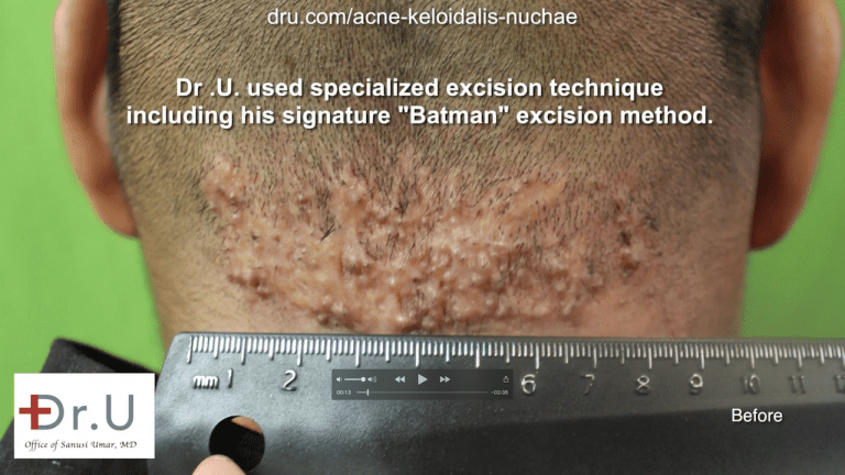 This Walnut Park patient endured symptoms of AKN like a bump on head for years before consulting at the Dr. U AKN Bump Clinic. This Walnut Park patient endured symptoms of AKN like a bump on head for years before consulting at the Dr. U AKN Bump Clinic.