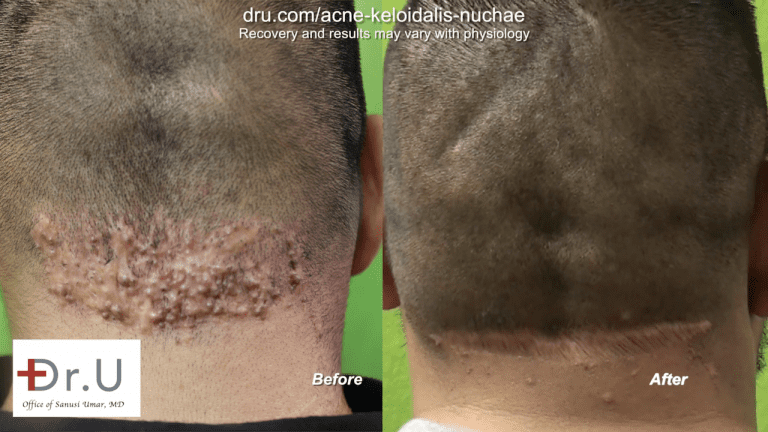 This patient finally found a cure for razor bumps behind head with Dr. U in Los Angeles. Dr. U's unique surgical excision technique helped return this patient to his normal cosmetic appearance.