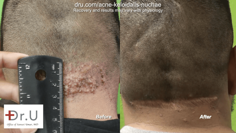 When a bump in back of head hurts, many do not know where to pursue treatment or what initial steps to take. This Walnut Park patient finally found a surgical cure for the AKN pimples on the back of the head and neck with Dr. U.* When a bump in back of head hurts, many do not know where to pursue treatment or what initial steps to take. This Walnut Park patient finally found a surgical cure for the AKN pimples on the back of the head and neck with Dr. U.*