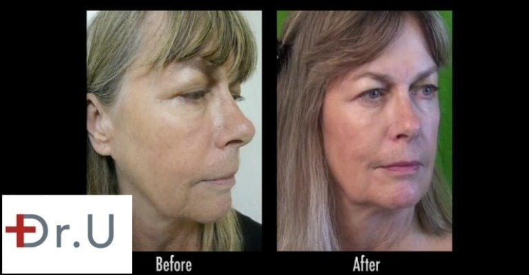 Radiesse is the best dermal filler for lifting many cases of jowls, non-surgically, as shown on this Los Angeles patient Radiesse is the best dermal filler for lifting many cases of jowls, non-surgically, as shown on this Los Angeles patient