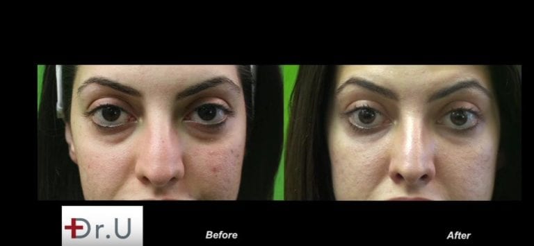 The best dermal filler injection for under the eyes will produce a natural looking outcome without incurring the Tyndall effect The best dermal filler injection for under the eyes will produce a natural looking outcome without incurring the Tyndall effect