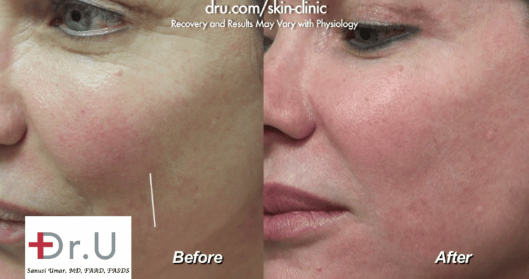 Determining which dermal filler is best often depends on the challenge that needs to be addressed. For this Los Angeles patient, Belotero was the best option to fill her fine line on the cheek