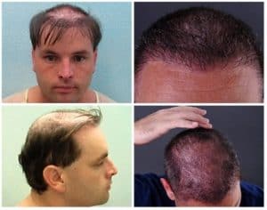Some individuals will resort to more extreme uses of wigs and hairpieces. Rather than using glue or double sided tape, this Los Angeles patient had his hairpiece stitched to his scalp, a mistake that became very difficult to reverse. Through a Dr.UGraft ™ body hair transplant, he defied his odds and achieved a normal, natural looking coverage.