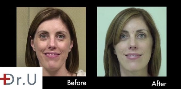 Hyaluronic acid fillers may be the best dermal filler injection for the early onset of laugh lines (nasolabial folds) Hyaluronic acid fillers may be the best dermal filler injection for the early onset of laugh lines (nasolabial folds)