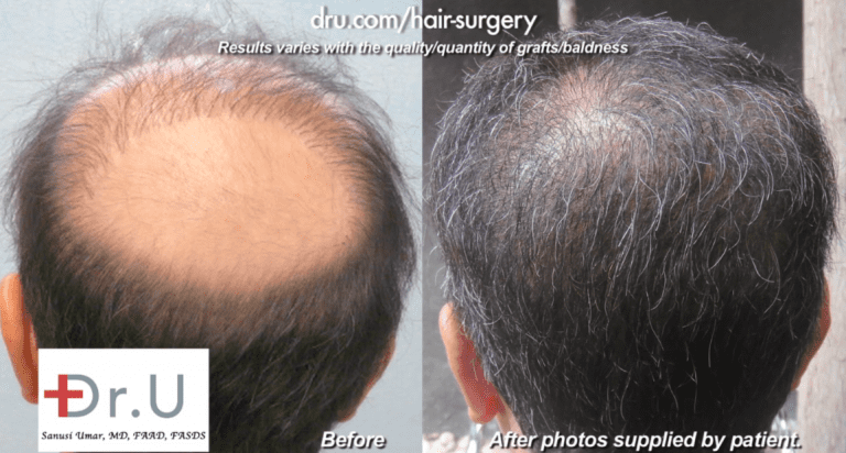 Wigs and hairpieces are commonly used by patients who fell victim to botched hair transplant results. This Los Angeles man used a toupee for fourteen years after a bad strip procedure left him with an exhausted donor supply and no hope of repair using scalp hair alone. Through a Dr.UGraft™ surgery using body hair grafts, he achieved the coverage that finally freed him completely from the use of hairpieces Wigs and hairpieces are commonly used by patients who fell victim to botched hair transplant results. This Los Angeles man used a toupee for fourteen years after a bad strip procedure left him with an exhausted donor supply and no hope of repair using scalp hair alone. Through a Dr.UGraft™ surgery using body hair grafts, he achieved the coverage that finally freed him completely from the use of hairpieces