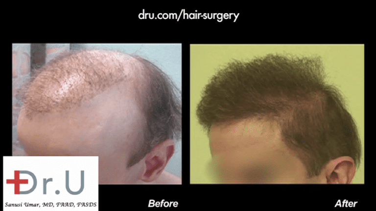 Is non-surgical hair replacement worth it? Most people would probably say no. But victims of bad hair restoration procedures may have no choice but to use some type of toupee to hide scarring and unsightly results, like this patient. With the help of a Dr.UGraft body hair to head procedure, he was able to discard his hairpiece and finally enjoy a sense of peace through a full head of naturally growing hair. Is non-surgical hair replacement worth it? Most people would probably say no. But victims of bad hair restoration procedures may have no choice but to use some type of toupee to hide scarring and unsightly results, like this patient. With the help of a Dr.UGraft body hair to head procedure, he was able to discard his hairpiece and finally enjoy a sense of peace through a full head of naturally growing hair.