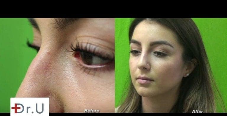 Radiesse, which is made of calcium hydroxyapatite, is perhaps the best dermal filler to use for non-surgical nose jobs Radiesse, which is made of calcium hydroxyapatite, is perhaps the best dermal filler to use for non-surgical nose jobs