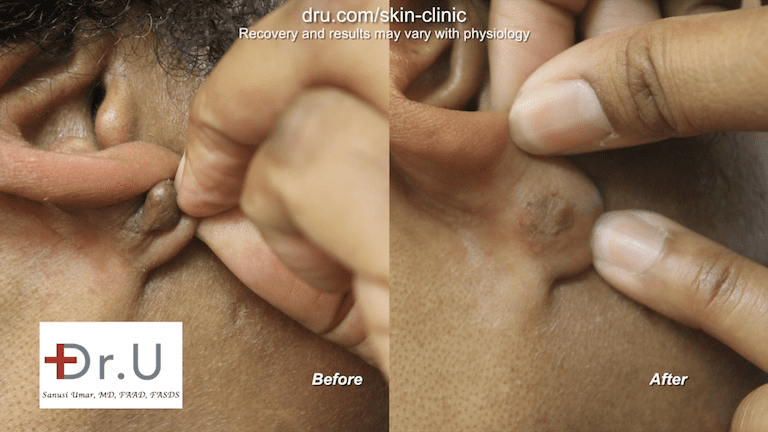 A keloid in an earlobe piercing may be effectively removed through flap excision surgery. Here are before and after photos of this patient's procedure.