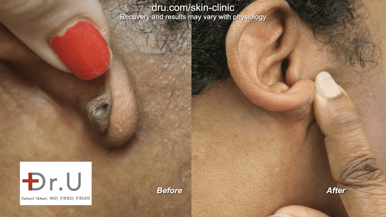 The large hard lump on the earlobe from keloid formation is no longer present The large hard lump on the earlobe from keloid formation is no longer present