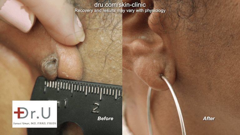 Brentwood patient is now able to wear her favorite earrings after her earlobe keloid removal surgery performed by Dr. U Brentwood patient is now able to wear her favorite earrings after her earlobe keloid removal surgery performed by Dr.U