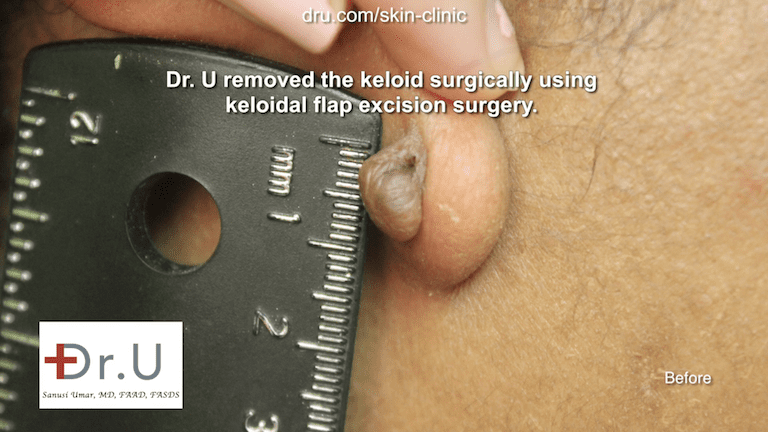 At almost one centimeter in length, surgery was needed to get rid of keloid on the earlobe At almost one centimeter in length, surgery was needed to get rid of keloid on the earlobe