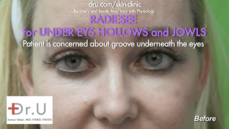 In addition to wanting to know how to get rid of jowls , the Manhattan Beach patient was also concerned about the hollows underneath her eyes, so Dr. U recommended Radiesse as an under eye hollows filler In addition to wanting to know how to get rid of jowls , the Manhattan Beach patient was also concerned about the hollows underneath her eyes, so Dr. U recommended Radiesse as an under eye hollows filler