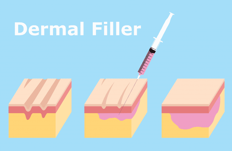 A rudimental illustration that shows how dermal fillers can be used to lift sagging jowls without surgery. A rudimental illustration that shows how dermal fillers can be used to lift sagging jowls without surgery.