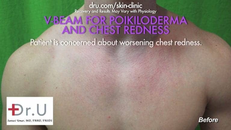 Patient showing redness on his chest before his laser treatment for rosacea Patient showing redness on his chest before his laser treatment for rosacea