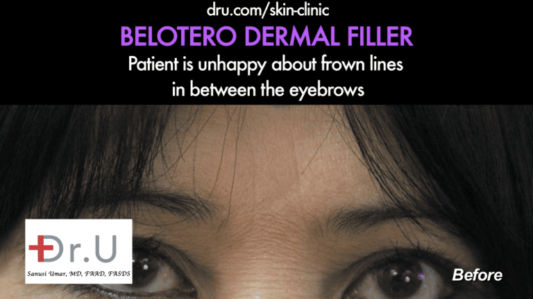 Malibu patient with 11's and superficial line on the side of her face. Dr. U recommended Belotero vs Botox for her treatment. Malibu patient with 11's and superficial line on the side of her face. Dr. U recommended Belotero vs Botox for her treatment.
