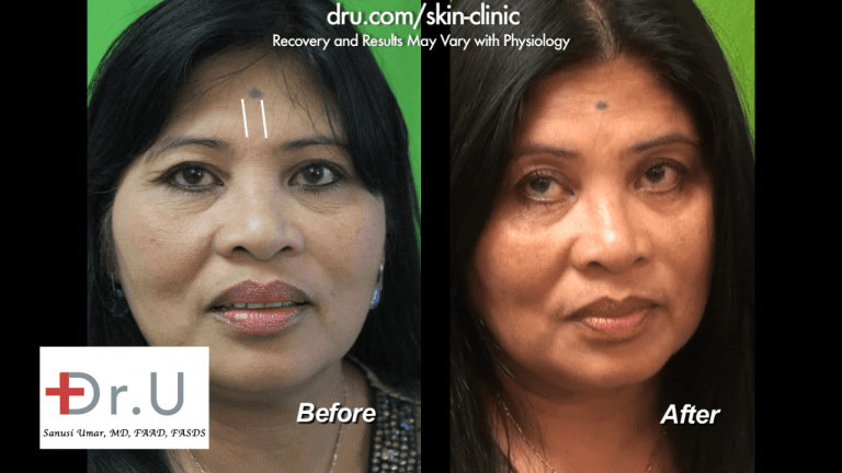 The white line shows where the application of the Belotero dermal filler will go to eliminate the unwanted 11's The white line shows where the application of the Belotero dermal filler will go to eliminate the unwanted 11's
