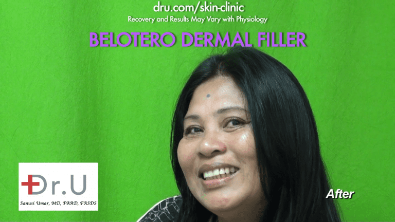 The Belotero dermal filler successfully eliminated the fine wrinkle wrinkles know as 11 between the eyes The Belotero dermal filler successfully eliminated the fine wrinkle wrinkles know as 11 between the eyes *