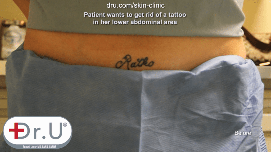 Manhattan Beach Patient Thrilled With Results After Laser