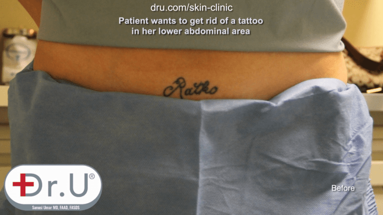 Does laser tattoo removal work? This Manhattan Beach patient wanted a tattoo removed from the abdominal area. Does laser tattoo removal work? This Manhattan Beach patient wanted a tattoo removed from the abdominal area.