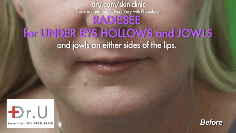 The Manhattan Beach patient wanted to know how to get rid of jowls without surgery, so she consulted Dr. U in his Los Angeles clinic. The Manhattan Beach patient wanted to know how to get rid of jowls without surgery, so she consulted Dr. U in his Los Angeles clinic.