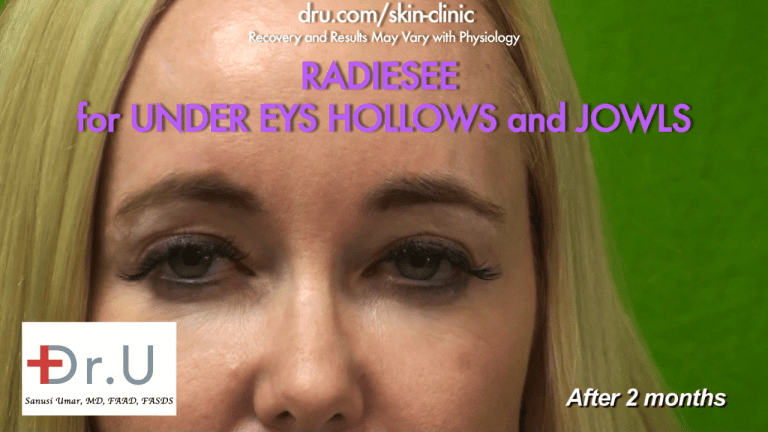 The Manhattan Beach patient's treatment with under eye hollows filler Radiesse was expertly injected by Dr. U The Manhattan Beach patient's treatment with under eye hollows filler Radiesse was expertly injected by Dr. U*
