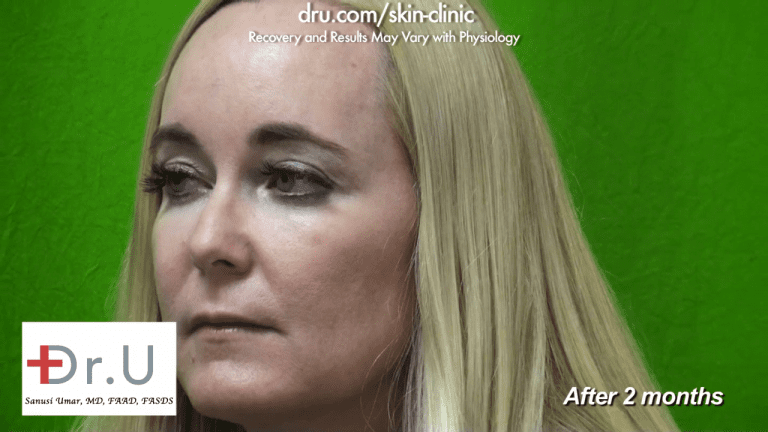 The Manhattan patient shows a side view after Dr. U used Radiesse to get rid of jowls without going under the knife.* The Manhattan patient shows a side view after Dr. U used Radiesse to get rid of jowls without going under the knife.*
