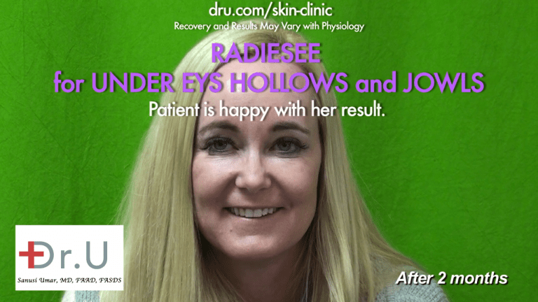 The Manhattan Beach patient was satisfied with the jowl lift with fillers and under eye hollows filler at Dr. U's Los Angeles based clinic* The Manhattan Beach patient was satisfied with the jowl lift with fillers and under eye hollows filler at Dr. U's Los Angeles based clinic*
