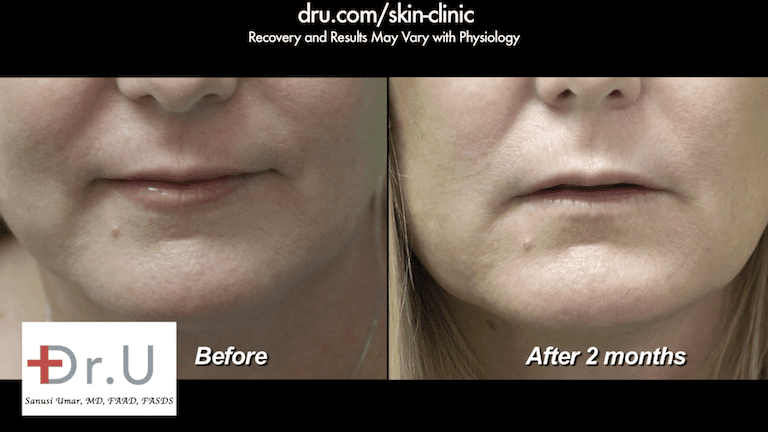 Manhattan Beach patient had a successful lift of sagging jowls without surgery at Dr. U's Los Angeles clinic, based in Redondo Beach*