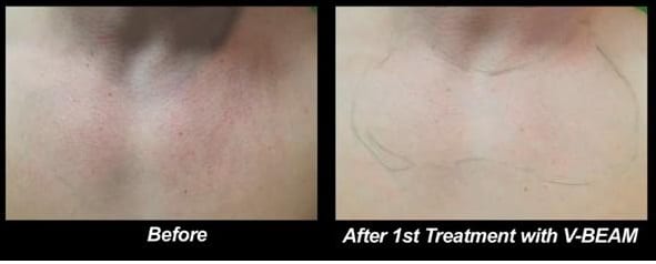 Before and after photos after patient's first treatment with the Vbeam laser treatment for Roseaca.