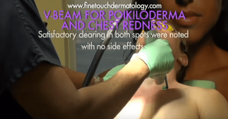 Dr.U tests for clearing of redness and the possibility of side effects of Rosacea laser treatment with the Vbeam