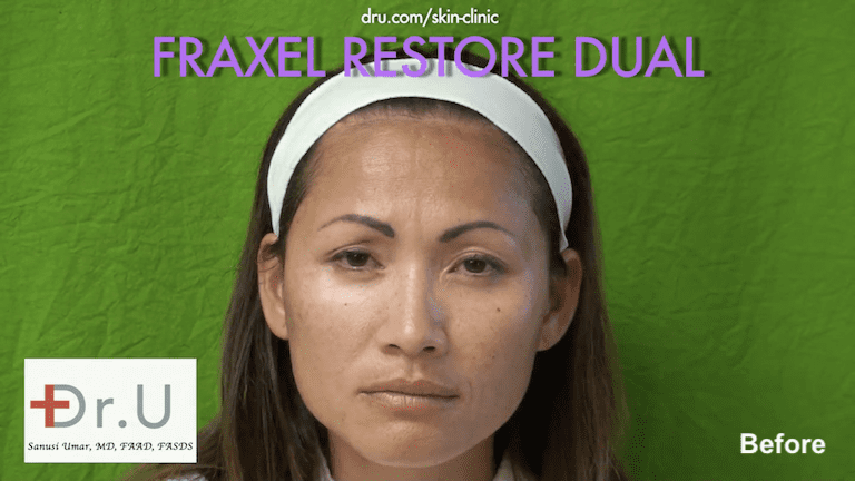 Beverly Hills patient sought fractional laser skin resurfacing for sunspots, mild-moderate wrinkles, and enlarged pores Beverly Hills patient sought fractional laser skin resurfacing for sunspots, mild-moderate wrinkles, and enlarged pores