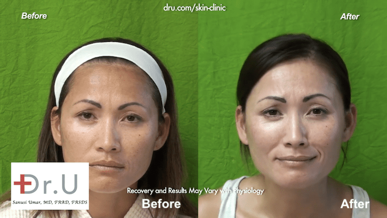 Beverly Hills patients laser skin resurfacing before and after results. Beverly Hills patients laser skin resurfacing before and after results.