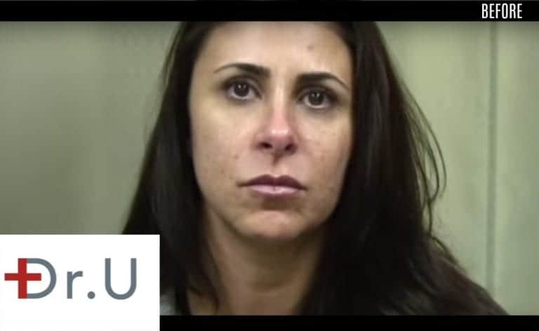 Westlake Village, Los Angeles patient before her treatment with a laugh lines filler. Westlake Village, Los Angeles patient before her treatment with a laugh lines filler.