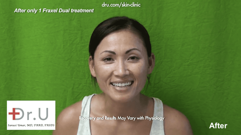 Beverly Hills, Los Angeles patient after 1 session with the Fraxel Dual laser for laser skin resurfacing.