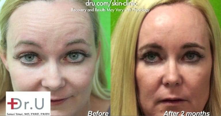Patient is happy with her outcome using Botox for forehead wrinkles & crows feet.* Patient is happy with her outcome using Botox for forehead wrinkles & crows feet.*
