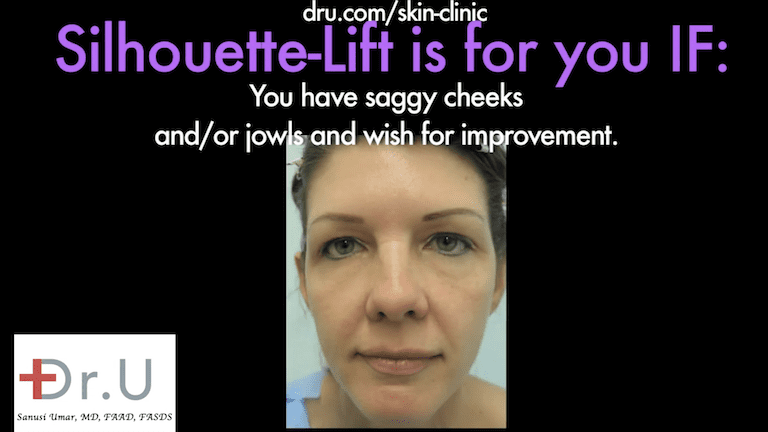 Beverly Hills patient with deep laugh lines before her Silhouette Lift procedure. Beverly Hills patient with deep laugh lines before her Silhouette Lift procedure.