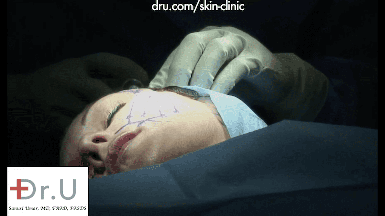 Dr. U marks the patient's face for her Silhouette Lift procedure. Dr. U marks the patient's face for her Silhouette Lift procedure.
