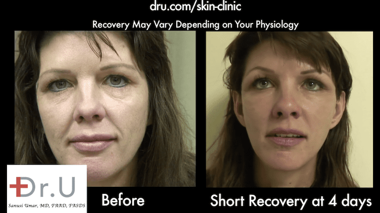 Patient's nasolabial folds show major improvement 4 days after her Silhouette Lift. Patient's nasolabial folds show major improvement 4 days after her Silhouette Lift