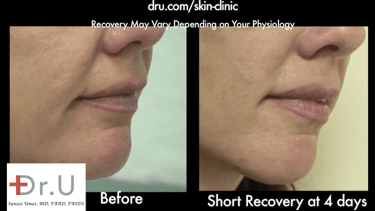 Sagging cheeks no longer produce a fold over effect thanks to the Silhouette Facelift.