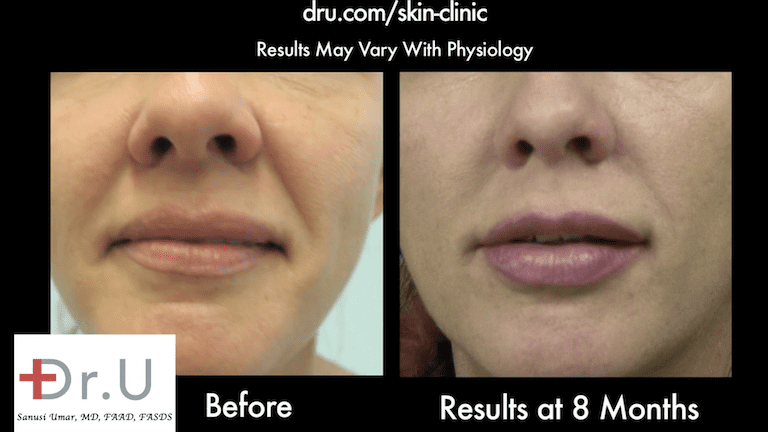 Dr. U's Silhouette thread face lift helped pull back patient's sagging cheeks. Dr. U's Silhouette thread face lift helped pull back patient's sagging cheeks.