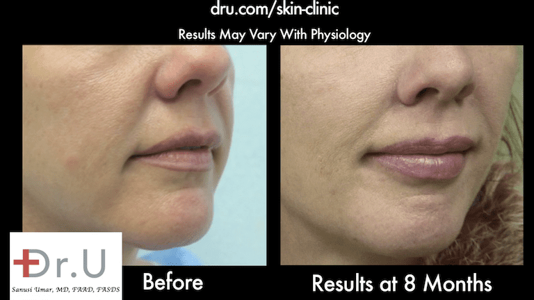 Dr.U's Silhouette non surgical Lift, combined with hyaluronic acid filler, created an incredibly natural looking improvement for the laugh line and cheeks. Dr.U's Silhouette non surgical Lift, combined with hyaluronic acid filler, created an incredibly natural looking improvement for the laugh line and cheeks.