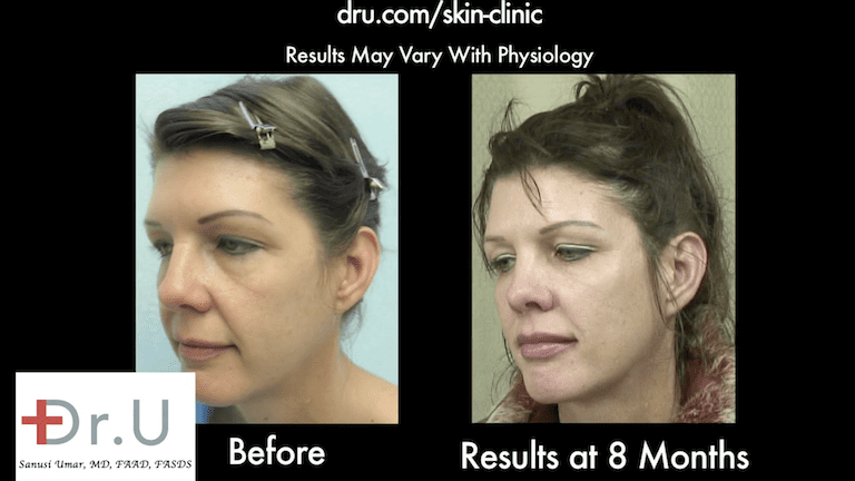 Patient's drooping cheeks no longer produce an overlap, folding effect after treatment with Dr.U's Silhouette Lift and fillers. Patient's drooping cheeks no longer produce an overlap, folding effect after treatment with Dr.U's Silhouette Lift and fillers.