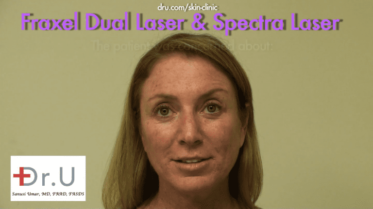 This patient from El Segundo, Los Angeles consulted Dr. U about age spots on face and neck areas. The appearance of the brown dots concerned her. This patient from El Segundo, Los Angeles consulted Dr. U about age spots on face and neck areas. The appearance of the brown dots concerned her.