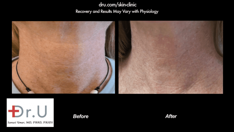 The patient was happy to get rid of not just the age spots on face, but those on her neck as well. The patient was happy to get rid of not just the age spots on face, but those on her neck as well.