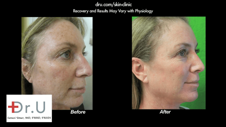 Profile view showing the other side of the patient's face after undergoing the best age spot remover treatment with Dr. U in Los Angeles.* Profile view showing the other side of the patient's face after undergoing the best age spot remover treatment with Dr. U in Los Angeles.*