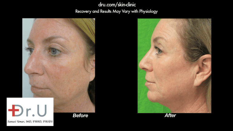 A profile view of the El Segundo, Los Angeles patient showing the results of removing age spots on face with laser therapy. A profile view of the El Segundo, Los Angeles patient showing the results of removing age spots on face with laser therapy.