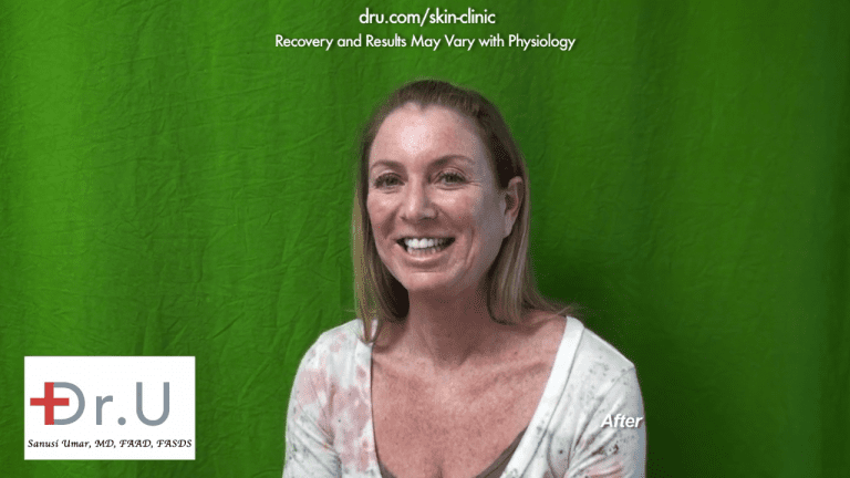 The patient was very happy and would recommend treatment with Dr. U to anyone wondering how to remove age spots on face. The patient was very happy and would recommend treatment with Dr. U to anyone wondering how to remove age spots on face.